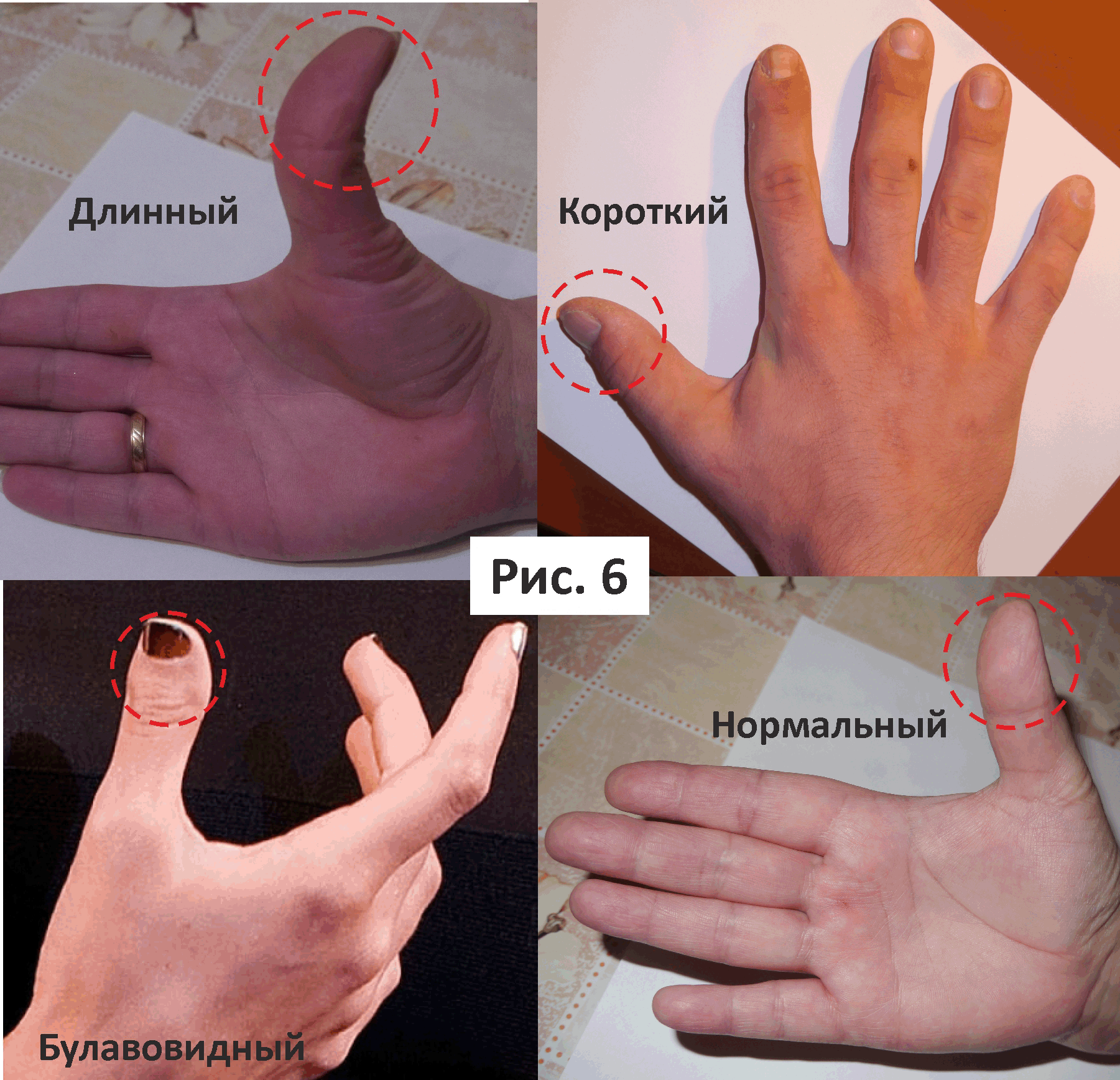 Изменение формы руки. Формы больших пальцев рук. Форма большого пальца на руке. Широкие фаланги пальцев.
